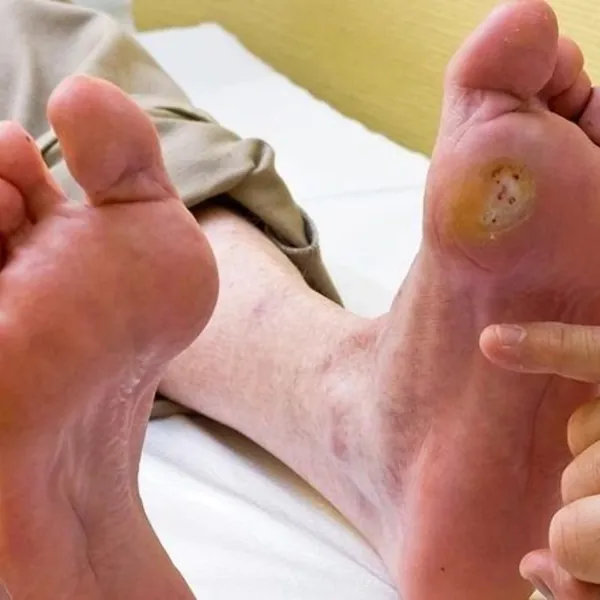 Phân biệt hai loại vết thương loét bàn chân