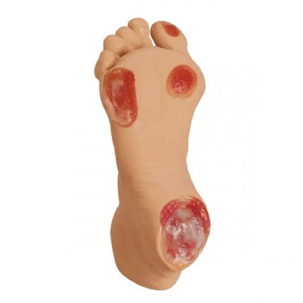 Điều trị loét bàn chân do tiểu đường