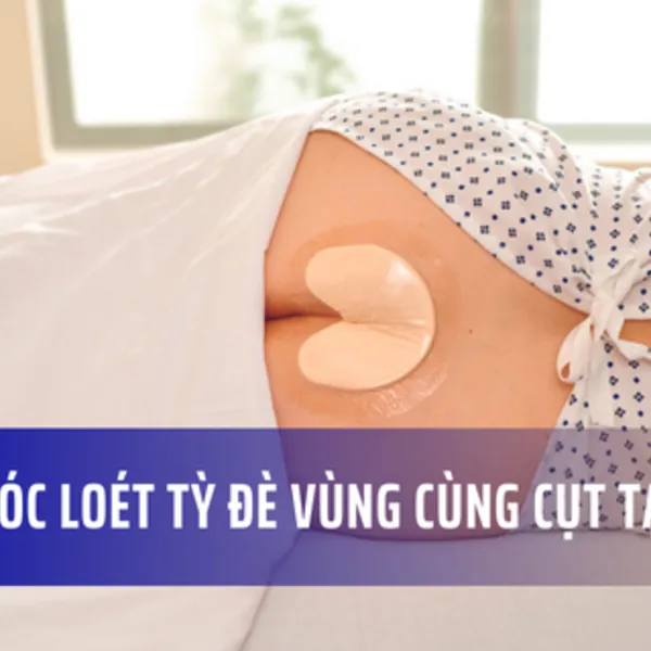 Cách chăm sóc vết loét vùng cùng cụt tại nhà
