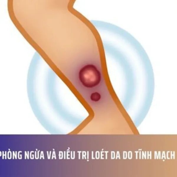 Cách Phòng Ngừa và Điều Trị Loét Da Do Tĩnh Mạch Ở Chân