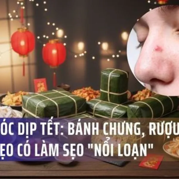 Chăm Sóc Sẹo Dịp Tết: Bánh chưng, Rượu Bia, Bánh Kẹo Có Làm Sẹo "Nổi Loạn"?