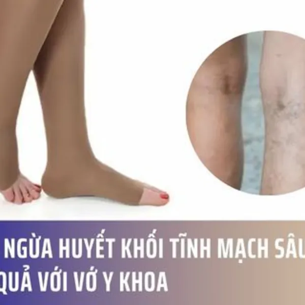 Ngăn ngừa huyết khối tĩnh mạch sâu (DVT) hiệu quả với Vớ y khoa