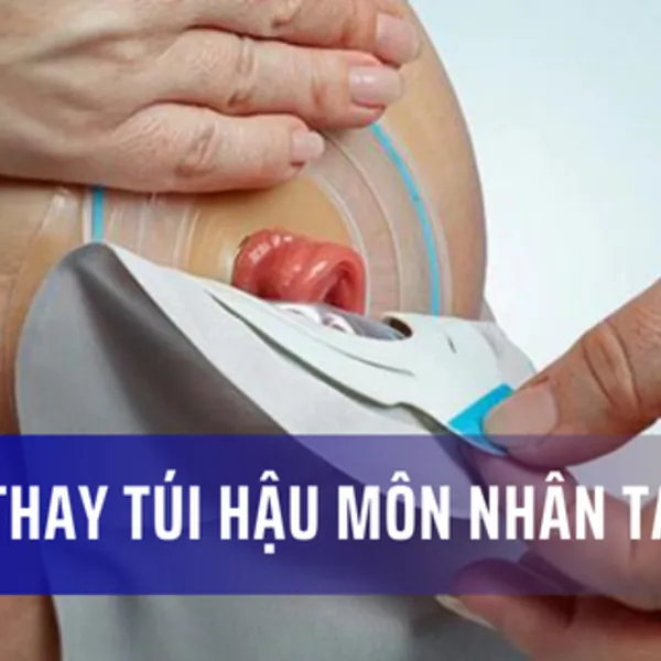 Video hướng dẫn cách thay túi hậu môn nhân tạo