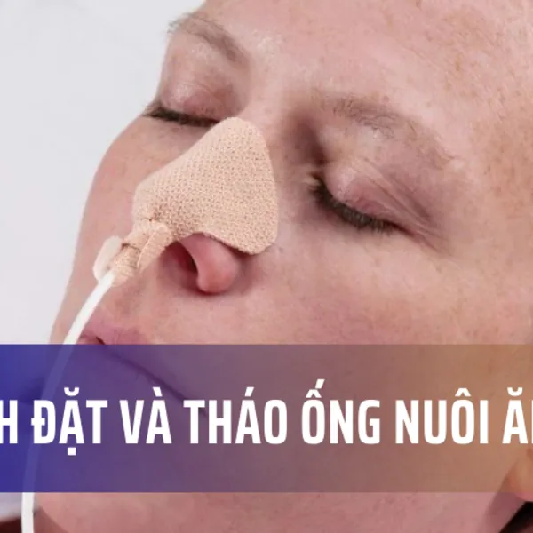 Cách đặt và tháo ống nuôi ăn
