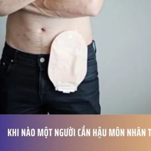 Khi nào một người cần hậu môn nhân tạo