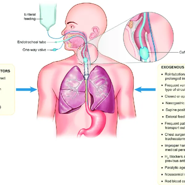 Vấn đề viêm phổi (VAP) trên bệnh nhân thông khí nhân tạo