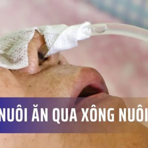 Cách nuôi ăn bằng xông nuôi ăn (dinh dưỡng qua đường ống)