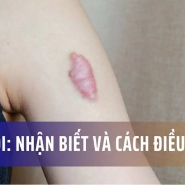 Sẹo lồi: Đặc điểm, nguyên nhân và cách điều trị
