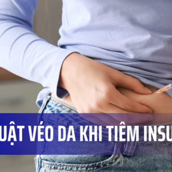 Bạn có cần phải véo da khi tiêm insulin không?