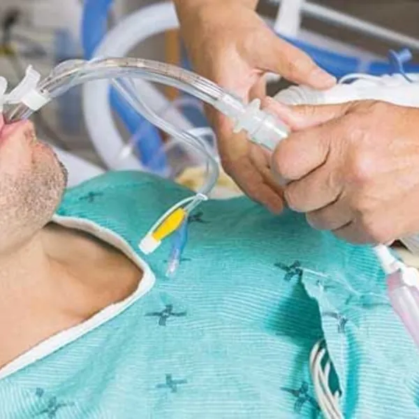 Những tiến bộ công nghệ trong ống nội khí quản để ngăn ngừa bệnh viêm phổi