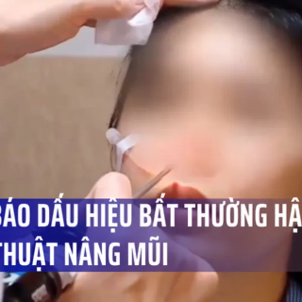Hậu phẫu thuật nâng mũi, bác sĩ thẩm mỹ cảnh báo dấu hiệu bất thường
