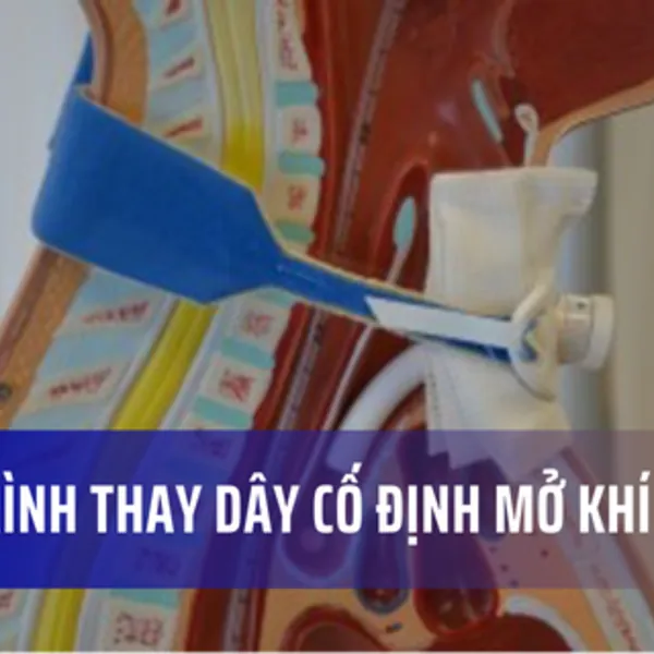 Chăm sóc mở khí quản: Thay dây cố định mở khí quản (Phần 2)