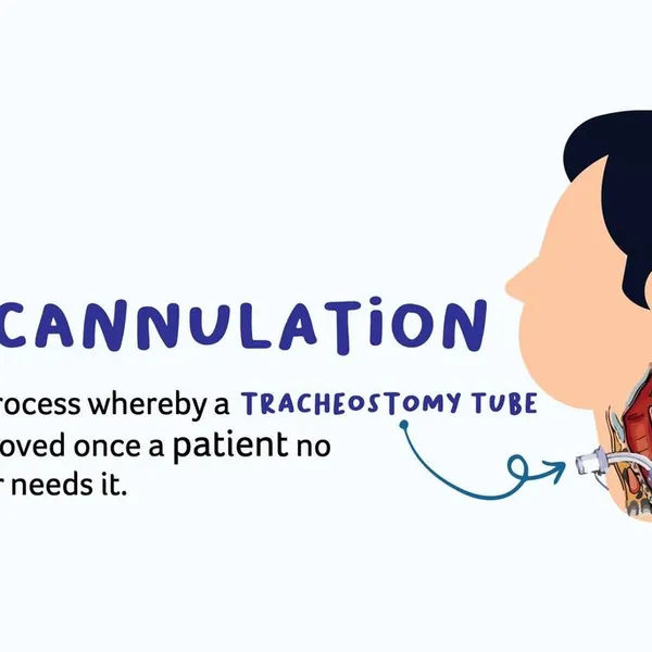 Các bước tiến hành kỹ thuật rút ống mở khí quản