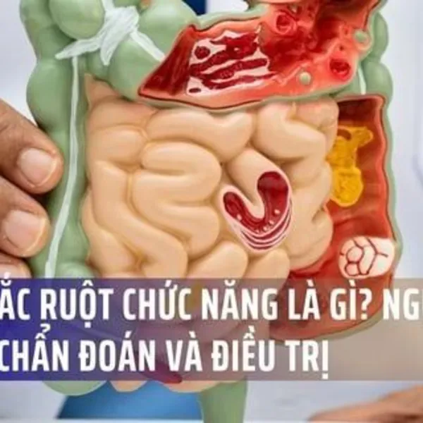 Bệnh Tắc Ruột Chức Năng (Ileus) Là Gì? Nguyên Nhân, Triệu Chứng, Chẩn Đoán Và Điều Trị