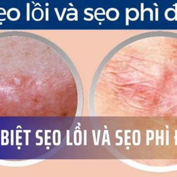 Phân biệt sẹo lồi và sẹo phì đại