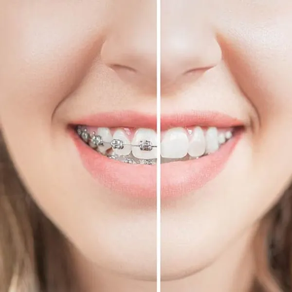 Hướng dẫn chăm sóc răng miệng tại nhà cho người niềng răng