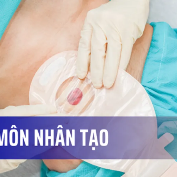 Những thông tin cơ bản về hậu môn nhân tạo (HMNT)