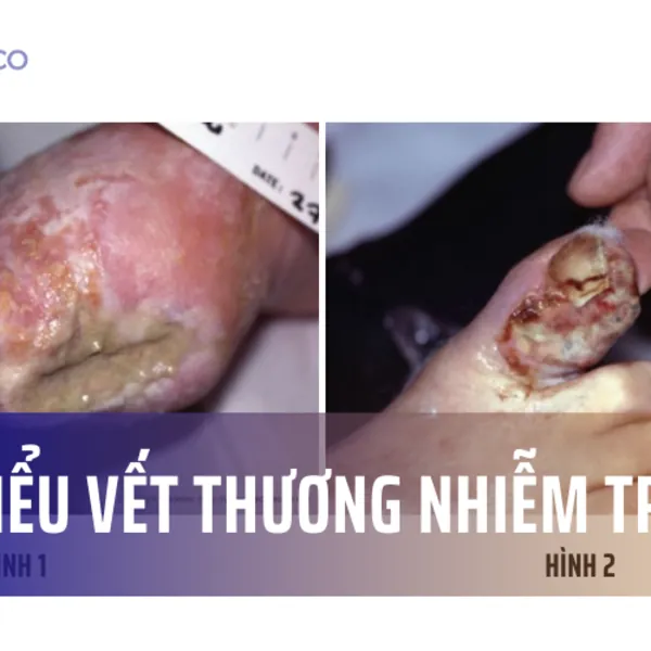 Tìm hiểu vết thương nhiễm trùng