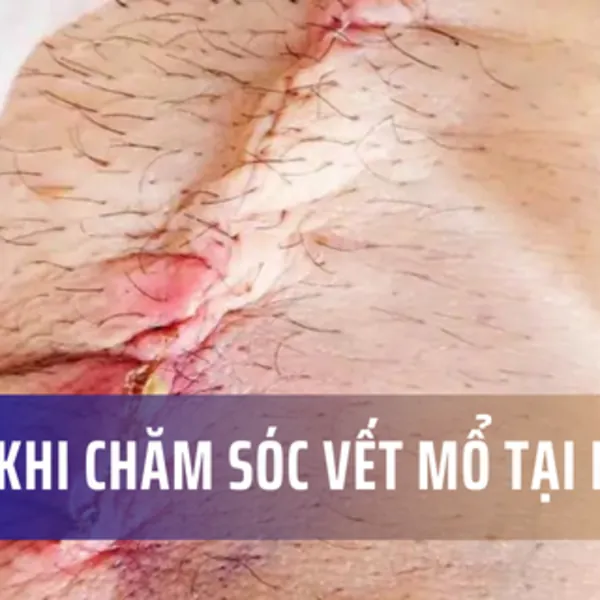 Những lưu ý khi chăm sóc vết mổ tại nhà