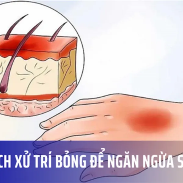 8 cách xử trí bỏng để ngăn ngừa sẹo