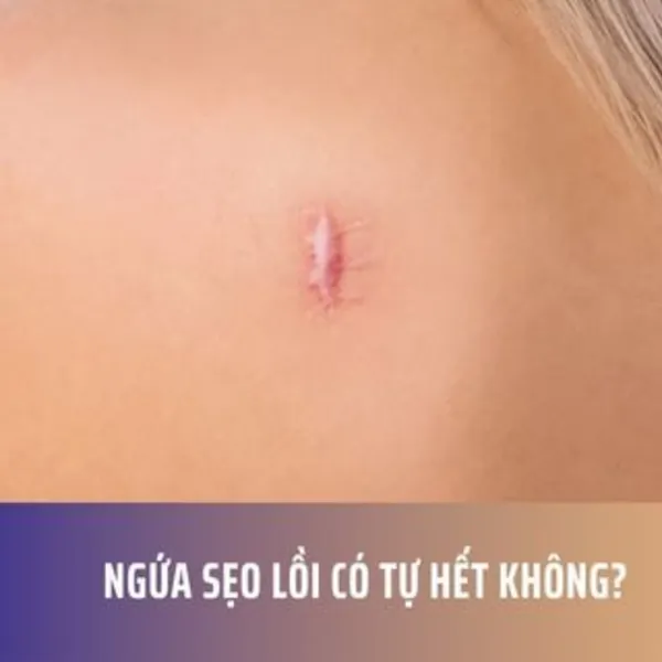 Ngứa Sẹo Lồi Có Tự Hết Không?