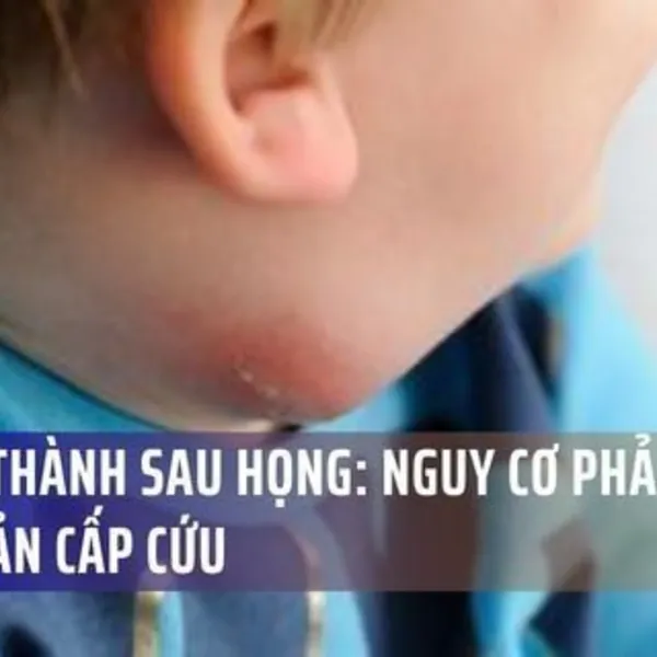 Áp Xe Thành Sau Họng: Cơn Ác Mộng Nghẹt Thở Và Nguy Cơ Phải Mở Khí Quản Cấp Cứu