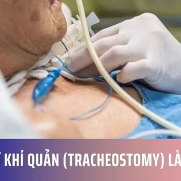Mở khí quản (Tracheostomy) là gì?