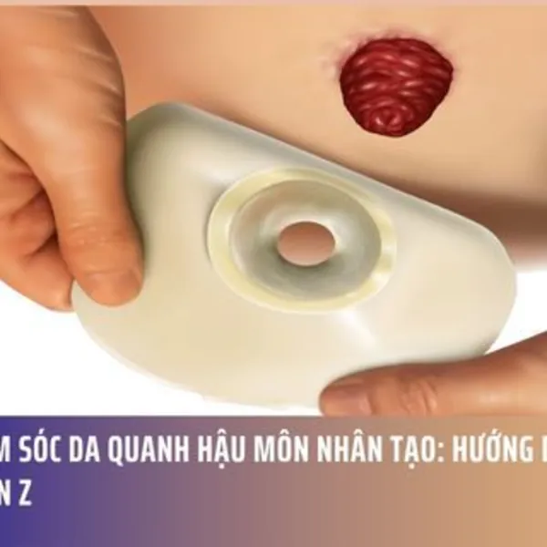 Chăm Sóc Da Quanh Hậu Môn Nhân Tạo: Hướng Dẫn Từ A Đến Z