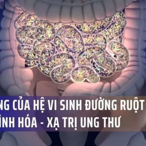 Tác động bất ngờ của hệ vi sinh đường ruột đến quá trình hóa - xạ trị ung thư