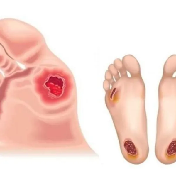 Làm gì khi bạn bị loét da?