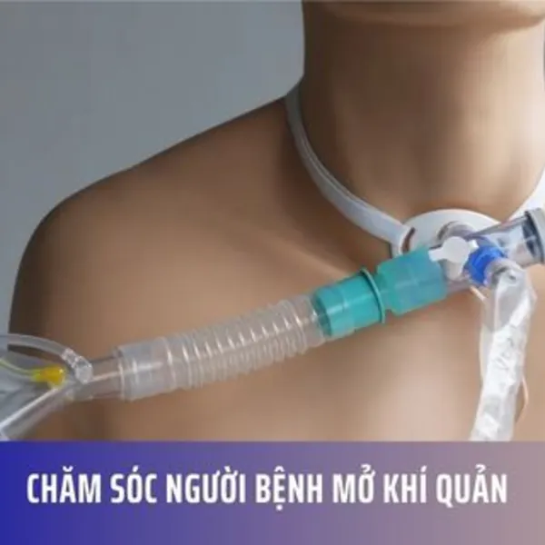 CHĂM SÓC NGƯỜI BỆNH MỞ KHÍ QUẢN - BẠN CẦN BIẾT