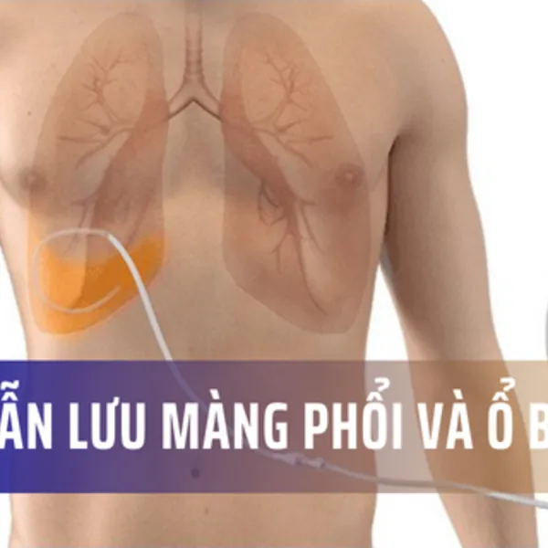 Tổng quan về ống dẫn lưu cho phổi và ổ bụng