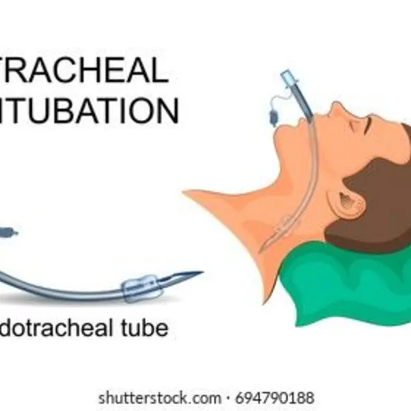 Tiến bộ công nghệ trong ống nội khí quản Ngăn ngừa sự hình thành màng sinh học