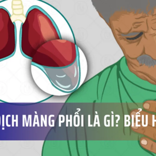 Tràn dịch màng phổi là gì? Nguyên nhân và Biểu hiện