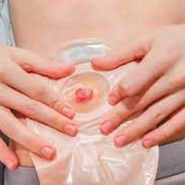 Rò rỉ chất thải qua lỗ mở hậu môn nhân tạo