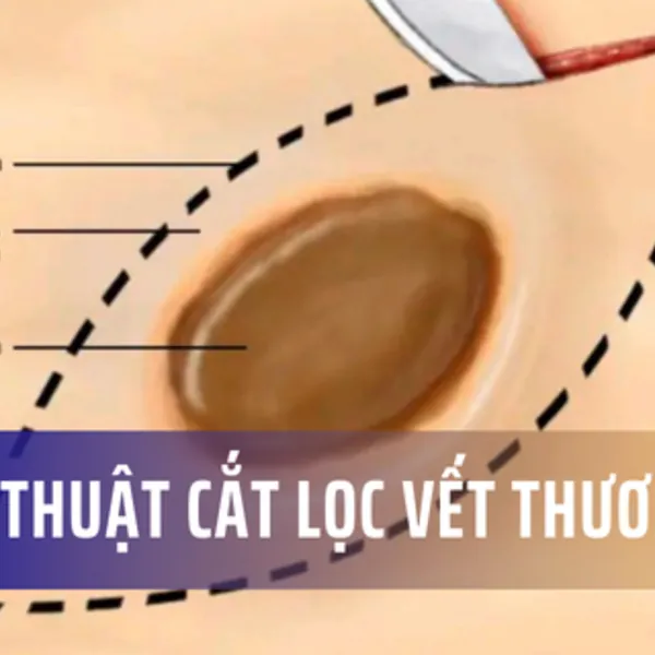 Phẫu thuật cắt lọc vết thương