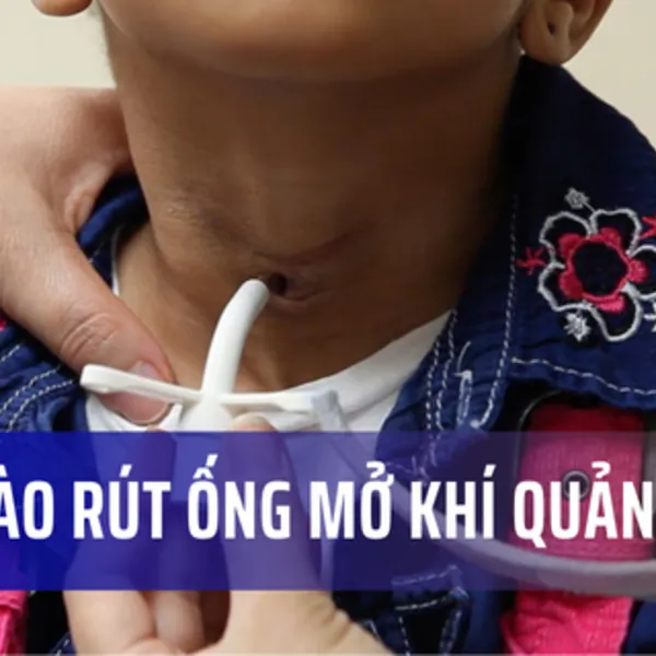 Khi nào người bệnh được rút ống mở khí quản?