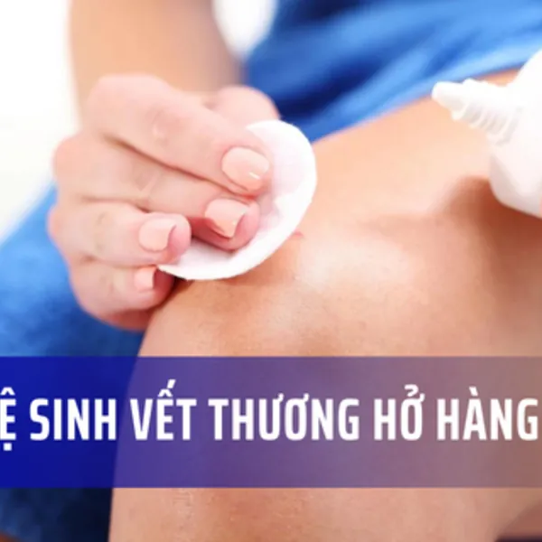 Cách vệ sinh vết thương hở hàng ngày