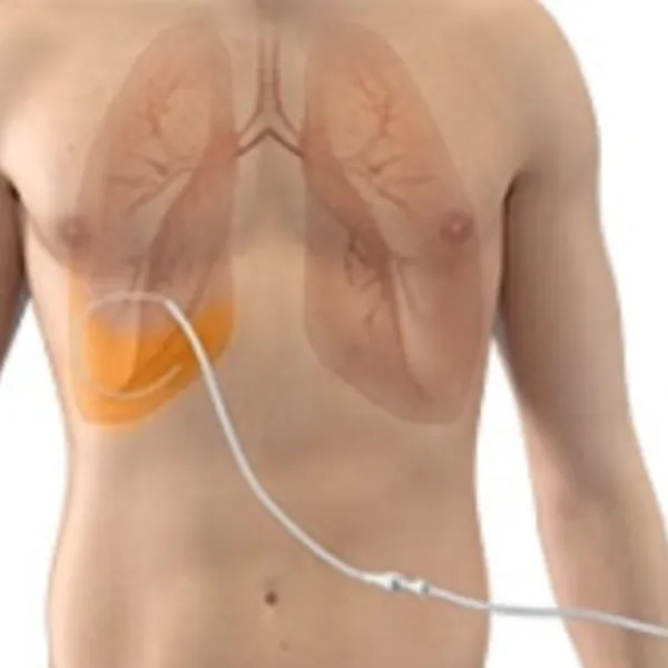 Đặt ống dẫn lưu tràn dịch màng phổi như thế nào?
