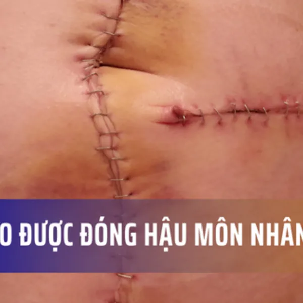 Khi nào người bệnh được đóng hậu môn nhân tạo?