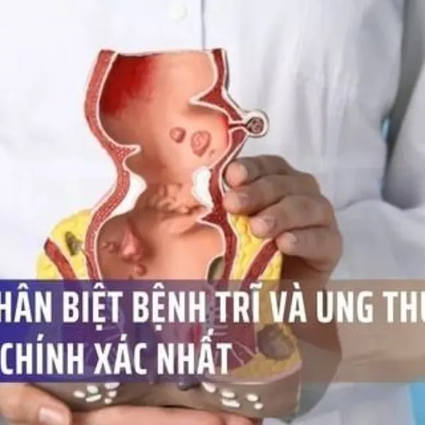 Cách Phân Biệt Bệnh Trĩ Và Ung Thư Đại Tràng Chính Xác Nhất