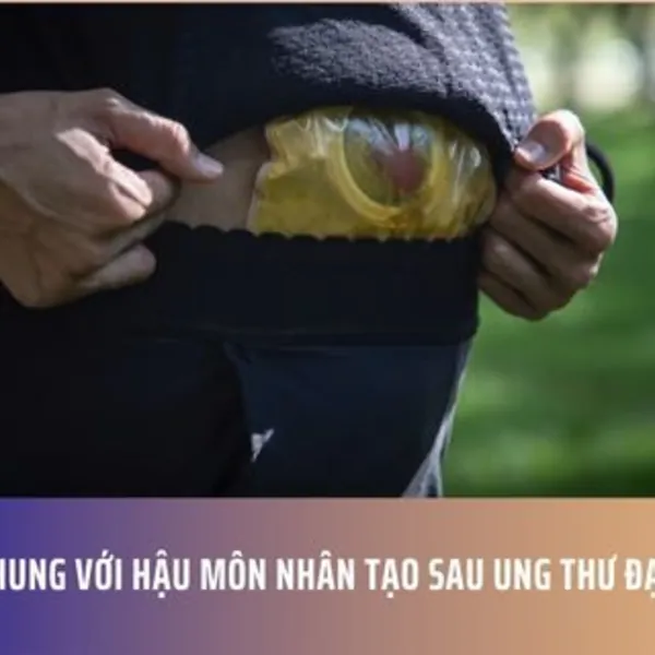 Sống Chung Với Hậu Môn Nhân Tạo Sau Ung Thư Đại Tràng