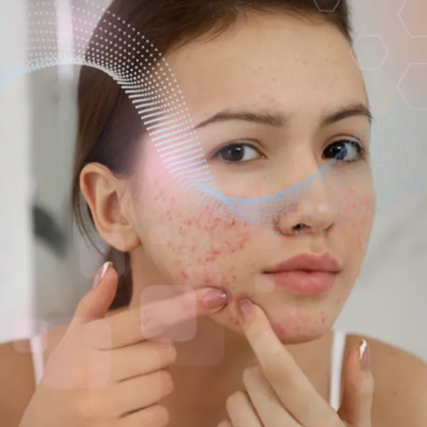 Lý do silicone gel được sử dụng nhiều trong các loại kem trị sẹo