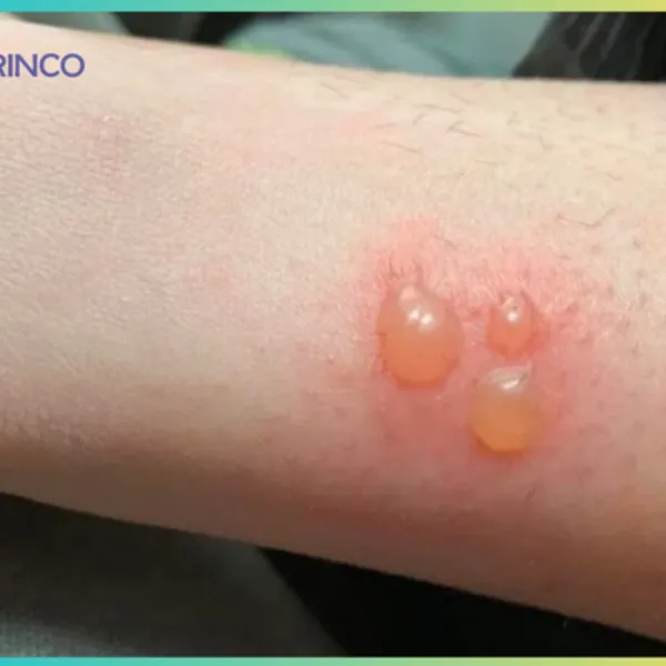 Bỏng rộp: Nên và không nên làm gì (Phần 1)