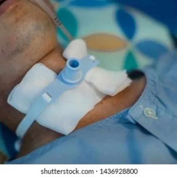 Chăm sóc mở khí quản và chăm sóc người bệnh có mở khí quản