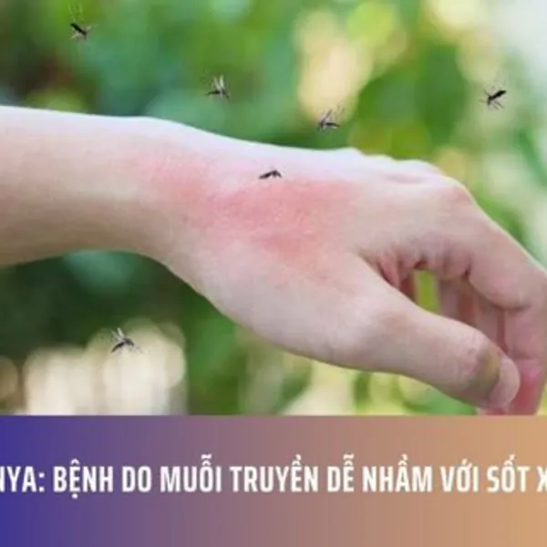 Chikungunya: Bệnh Do Muỗi Truyền Dễ Nhầm Với Sốt Xuất Huyết