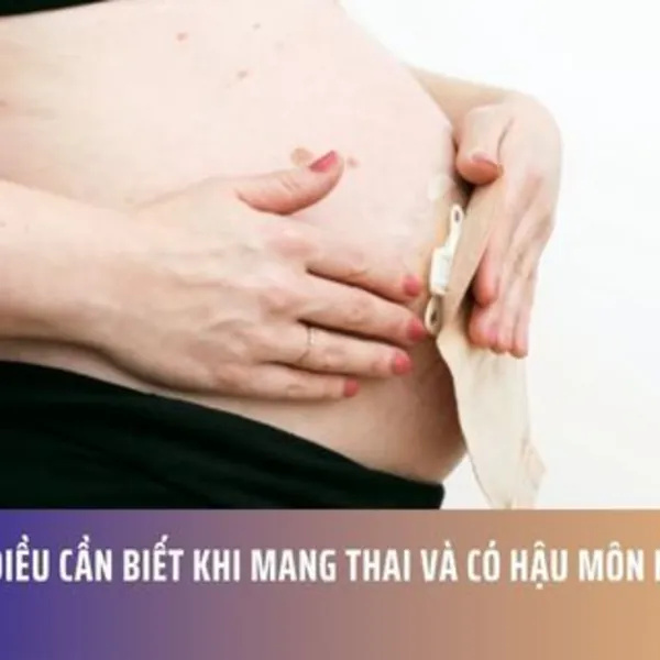 Những điều cần biết khi mang thai và có hậu môn nhân tạo