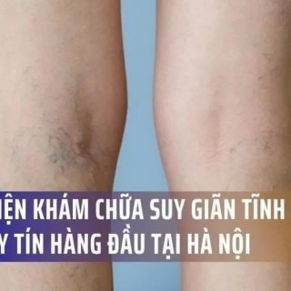 Top 5 Bệnh Viện Khám Chữa Suy Giãn Tĩnh Mạch Chân Uy Tín Hàng Đầu Tại Hà Nội
