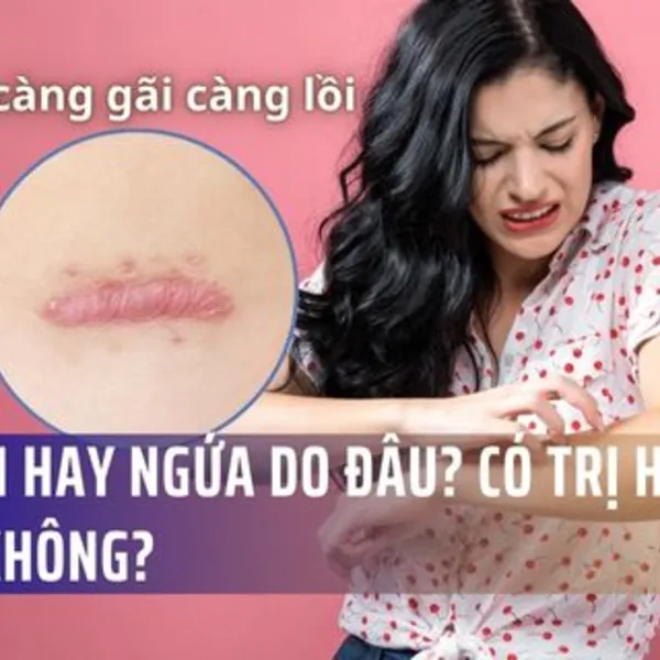 Sẹo lồi hay ngứa do đâu? Có trị hết được không?