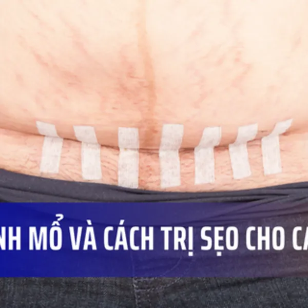 Sẹo sinh mổ và các cách trị sẹo dành cho các mẹ